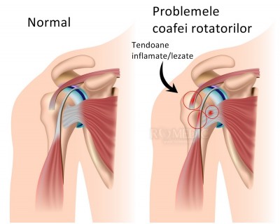 tratamentul cu lacrimă de tendon de umăr inflamație articulară pe degetul mic al tratamentului mâinii